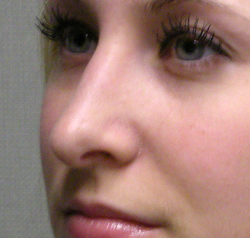 rhinoplasty after photo by michigan cosmetic surgery in southfield mi