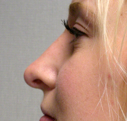 rhinoplasty after photo by michigan cosmetic surgery in southfield mi