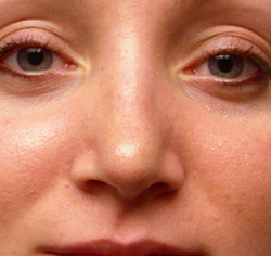 rhinoplasty after photo by michigan cosmetic surgery in southfield mi