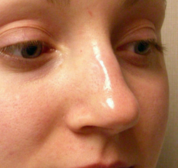 rhinoplasty before photo by michigan cosmetic surgery in southfield mi