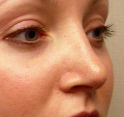 rhinoplasty after photo by michigan cosmetic surgery in southfield mi