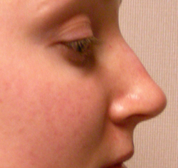 rhinoplasty before photo by michigan cosmetic surgery in southfield mi