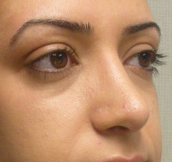 rhinoplasty after photo by michigan cosmetic surgery in southfield mi