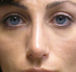 rhinoplasty after photo by michigan cosmetic surgery in southfield mi