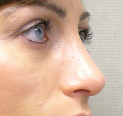 rhinoplasty after photo by michigan cosmetic surgery in southfield mi