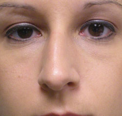 rhinoplasty before photo by michigan cosmetic surgery in southfield mi