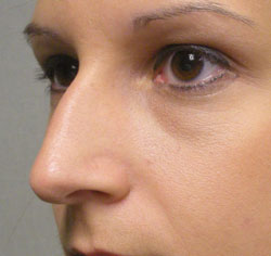 rhinoplasty before photo by michigan cosmetic surgery in southfield mi