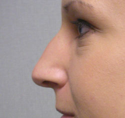 rhinoplasty before photo by michigan cosmetic surgery in southfield mi
