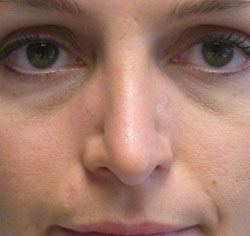 rhinoplasty after photo by michigan cosmetic surgery in southfield mi