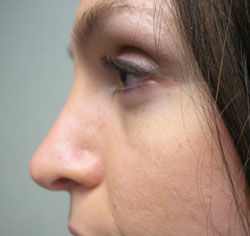 rhinoplasty after photo by michigan cosmetic surgery in southfield mi