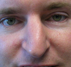 rhinoplasty before photo by michigan cosmetic surgery in southfield mi