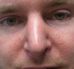 rhinoplasty after photo by michigan cosmetic surgery in southfield mi