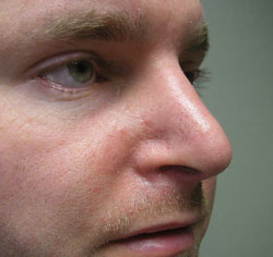 rhinoplasty after photo by michigan cosmetic surgery in southfield mi