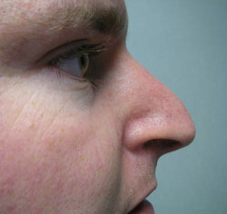 rhinoplasty before photo by michigan cosmetic surgery in southfield mi