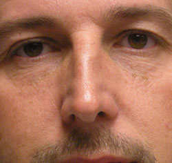 rhinoplasty before photo by michigan cosmetic surgery in southfield mi