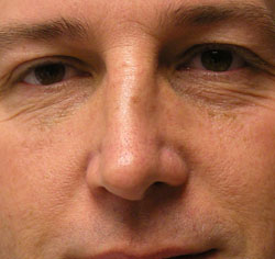 rhinoplasty after photo by michigan cosmetic surgery in southfield mi