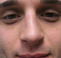 rhinoplasty after photo by michigan cosmetic surgery in southfield mi