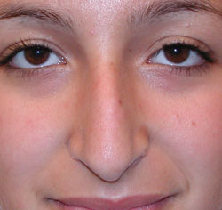 rhinoplasty before photo by michigan cosmetic surgery in southfield mi