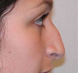 rhinoplasty before photo by michigan cosmetic surgery in southfield mi