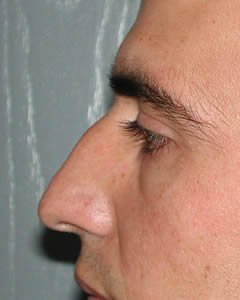 rhinoplasty before photo by michigan cosmetic surgery in southfield mi
