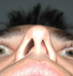 rhinoplasty before photo by michigan cosmetic surgery in southfield mi