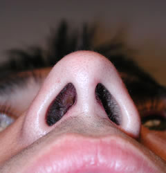 rhinoplasty after photo by michigan cosmetic surgery in southfield mi