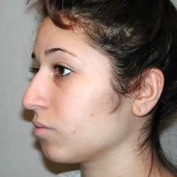 rhinoplasty before photo by michigan cosmetic surgery in southfield mi
