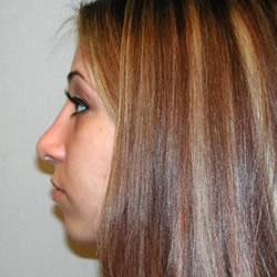 rhinoplasty after photo by michigan cosmetic surgery in southfield mi