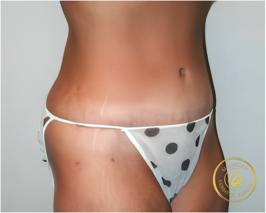 tummy tuck after photo by michigan cosmetic surgery in southfield mi