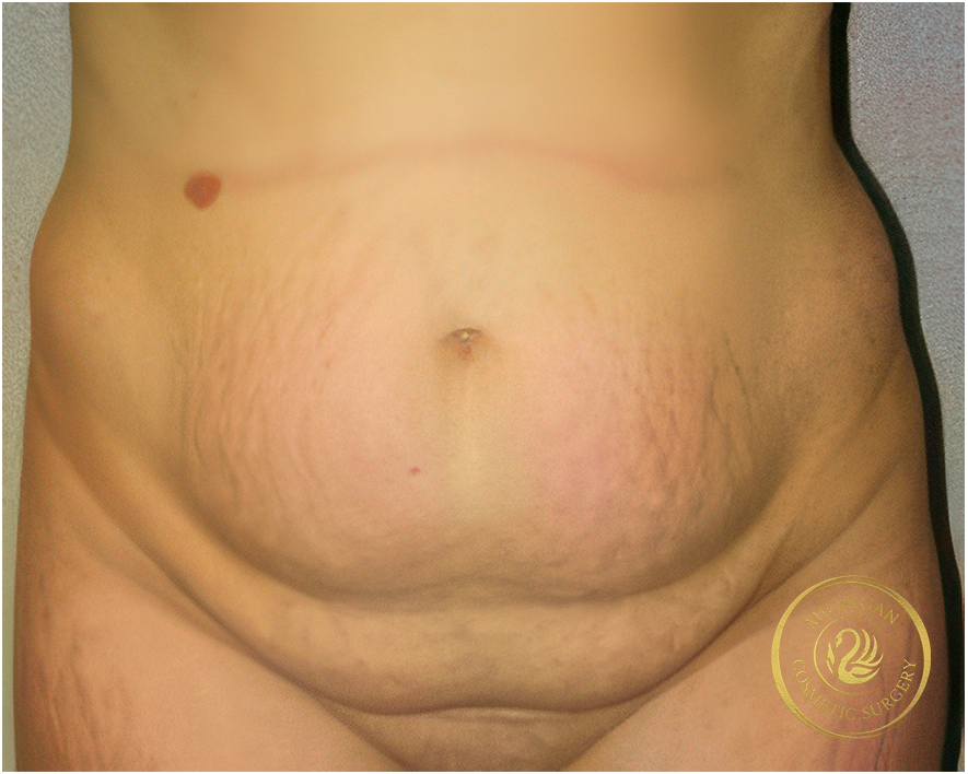 tummy tuck before photo by michigan cosmetic surgery in southfield mi tummy tuck before photo by michigan cosmetic surgery in southfield mi