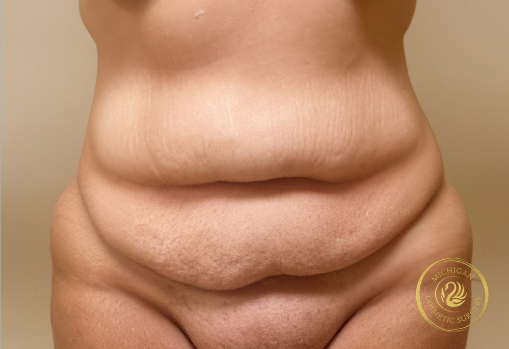 tummy tuck before photo by michigan cosmetic surgery in southfield mi tummy tuck before photo by michigan cosmetic surgery in southfield mi