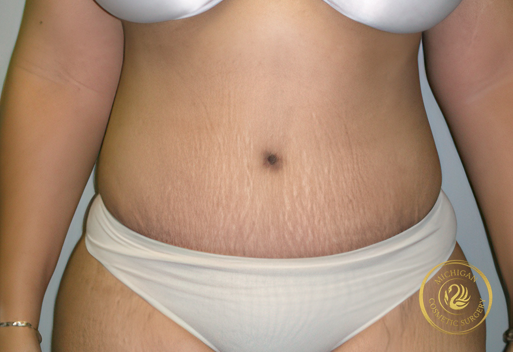 tummy tuck after photo by michigan cosmetic surgery in southfield mi