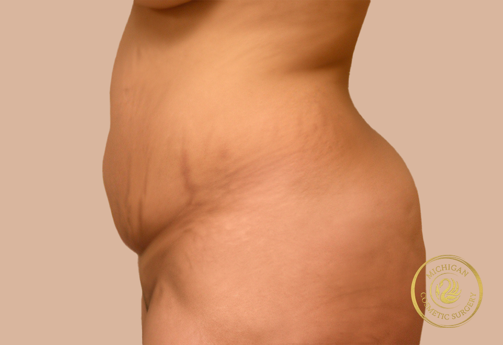 tummy tuck before photo by michigan cosmetic surgery in southfield mi tummy tuck before photo by michigan cosmetic surgery in southfield mi