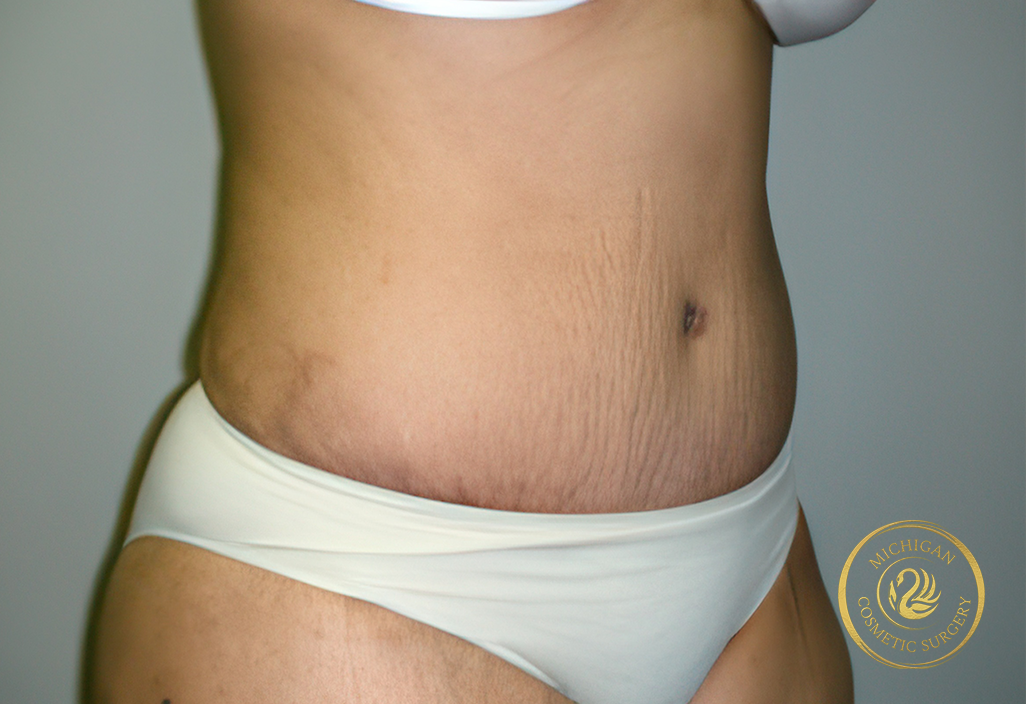 tummy tuck after photo by michigan cosmetic surgery in southfield mi