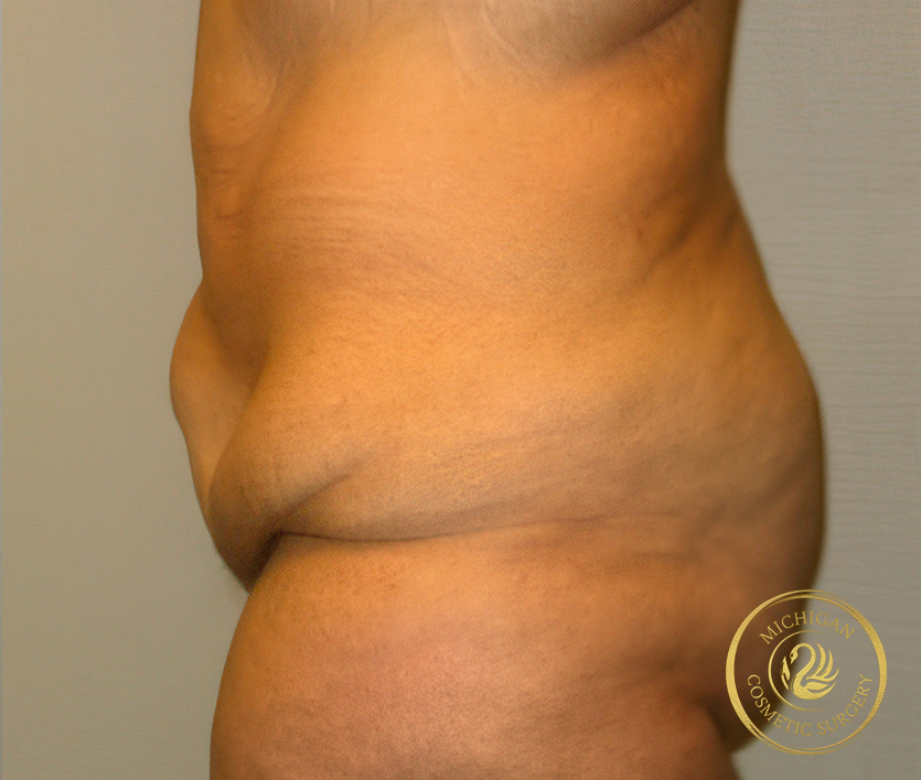 tummy tuck before photo by michigan cosmetic surgery in southfield mi tummy tuck before photo by michigan cosmetic surgery in southfield mi
