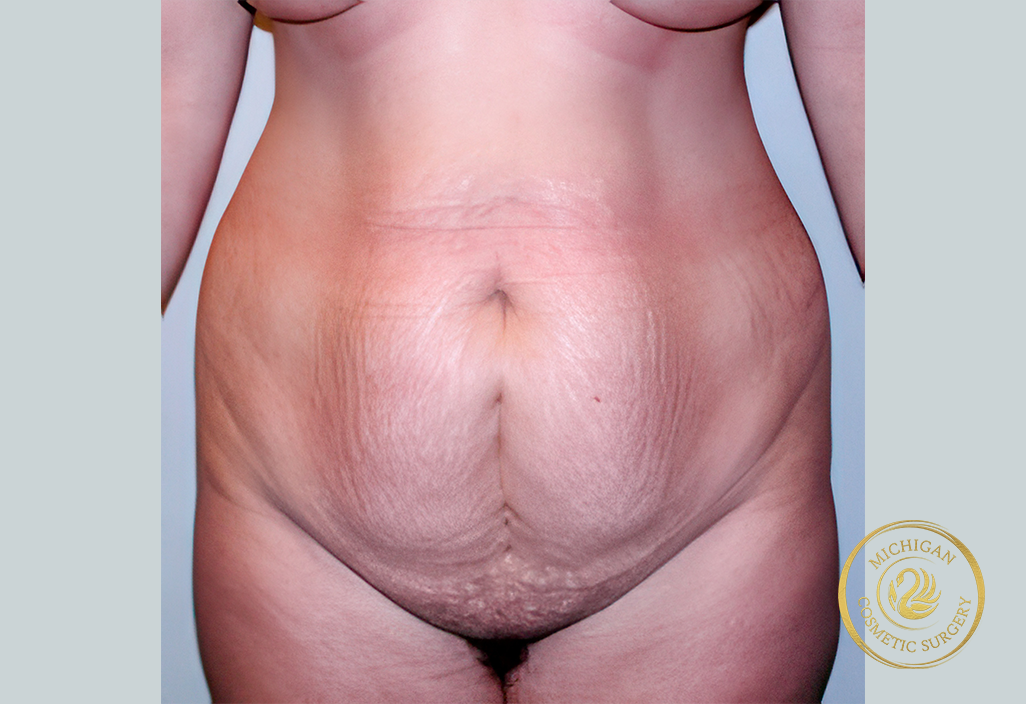 tummy tuck before photo by michigan cosmetic surgery in southfield mi