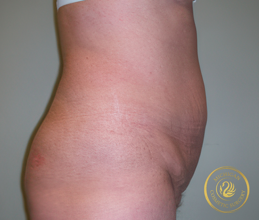 tummy tuck after photo by michigan cosmetic surgery in southfield mi tummy tuck before photo by michigan cosmetic surgery in southfield mi