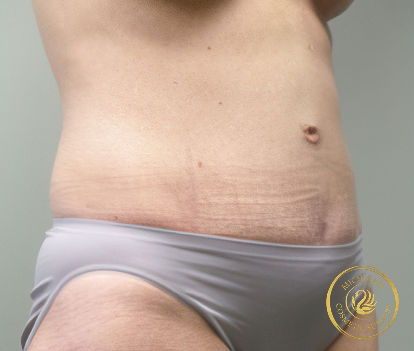 tummy tuck after photo by michigan cosmetic surgery in southfield mi