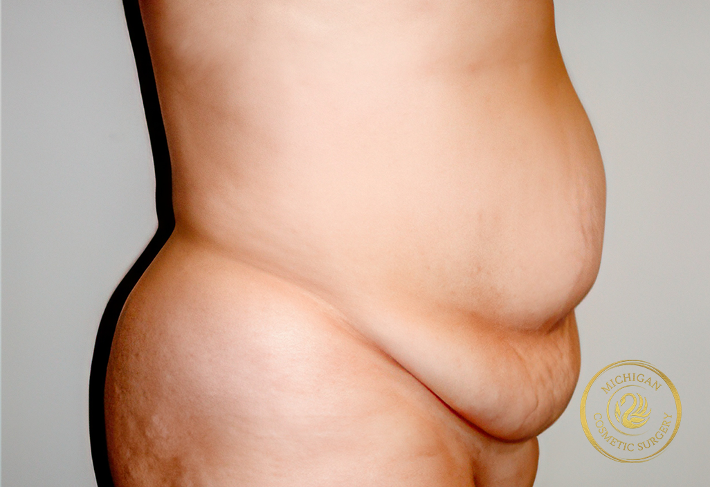 tummy tuck before photo by michigan cosmetic surgery in southfield mi