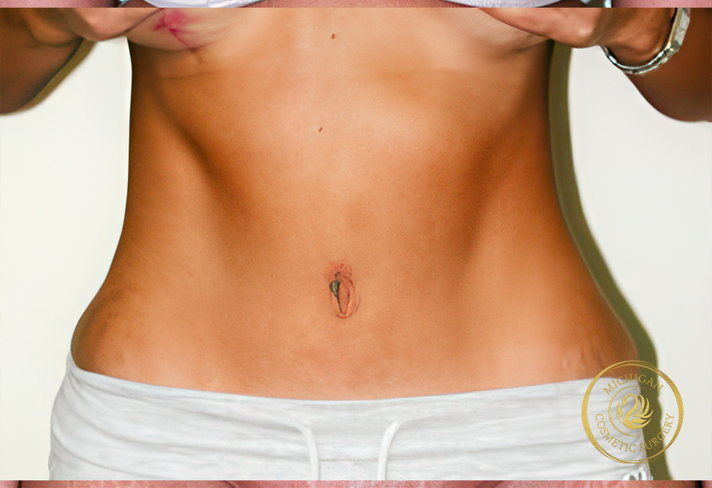 tummy tuck after photo by michigan cosmetic surgery in southfield mi