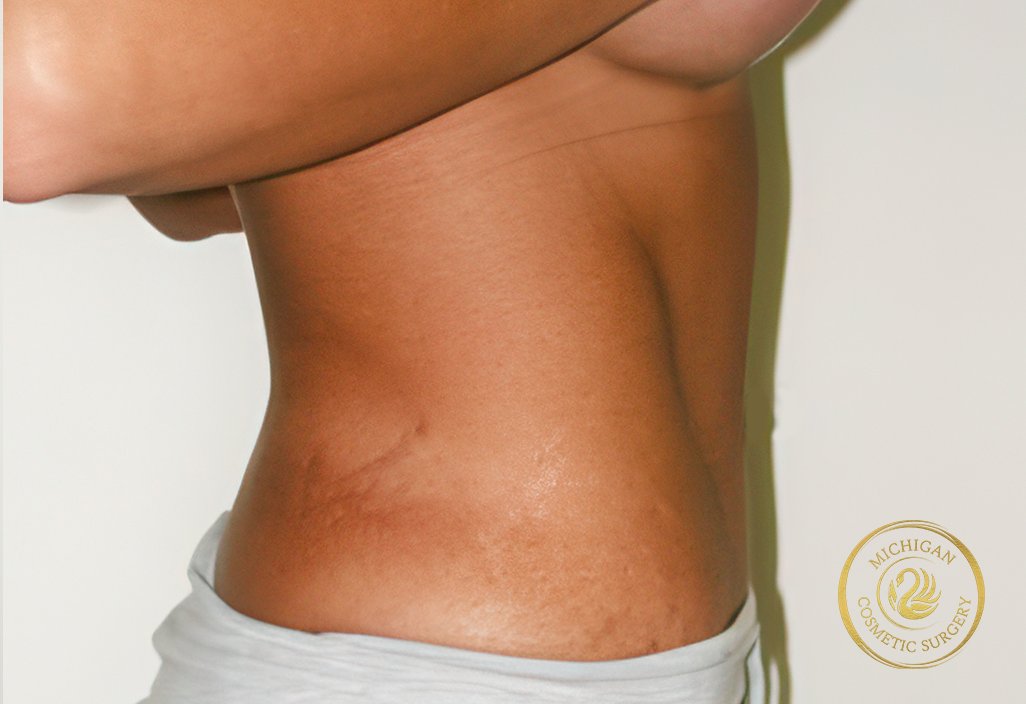 tummy tuck after photo by michigan cosmetic surgery in southfield mi