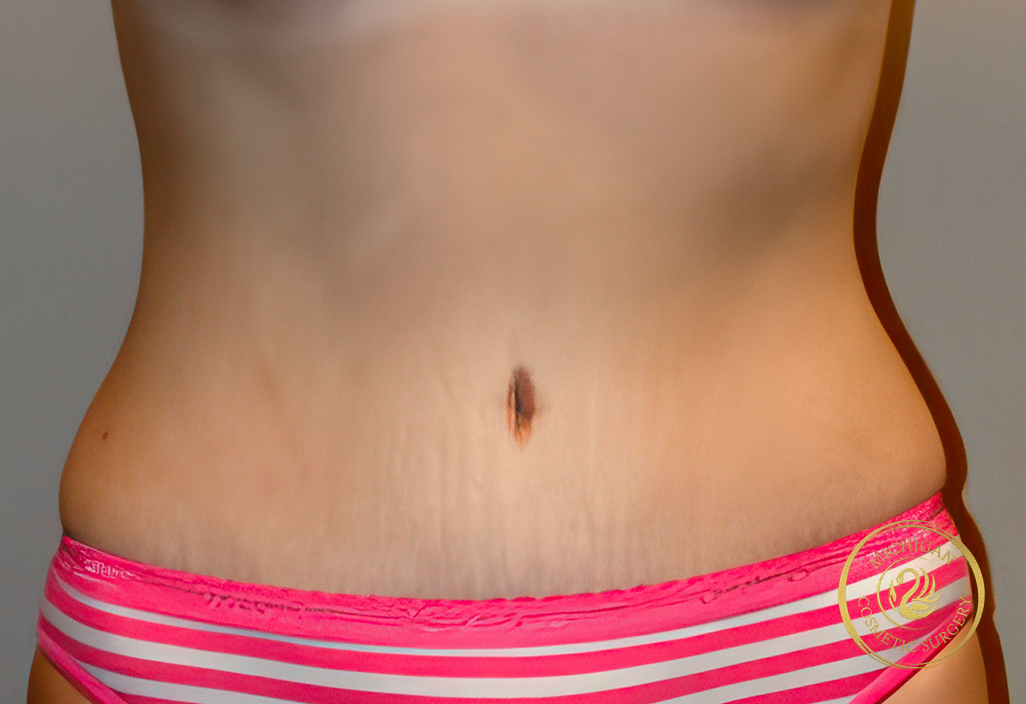 tummy tuck before photo by michigan cosmetic surgery in southfield mi