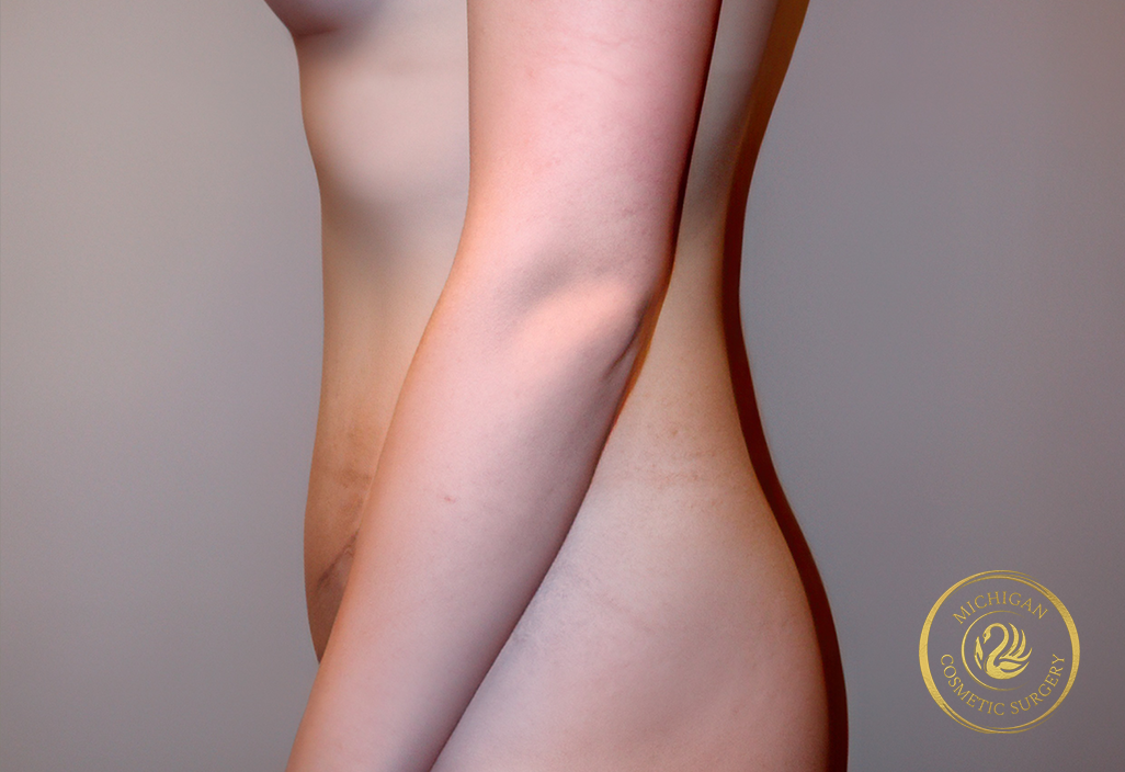 tummy tuck before photo by michigan cosmetic surgery in southfield mi