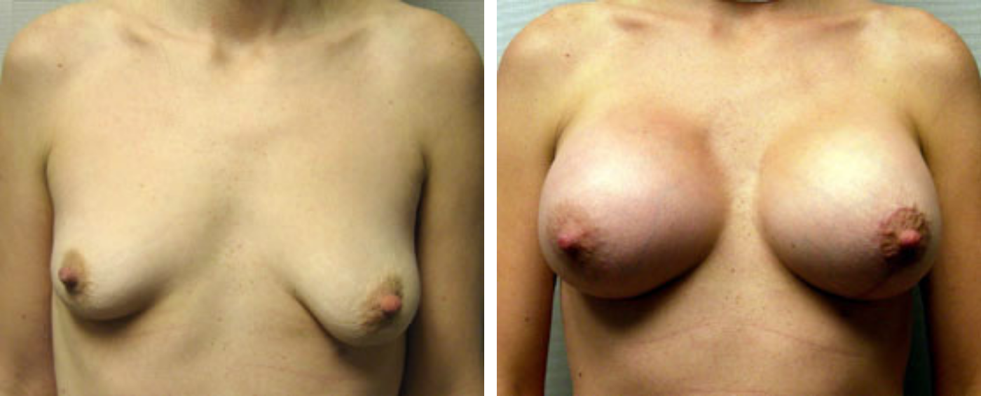 Breast Augmentation with Crescent lift a