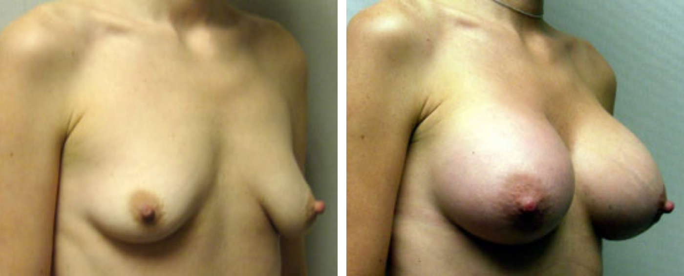 Breast Augmentation with Crescent lift b