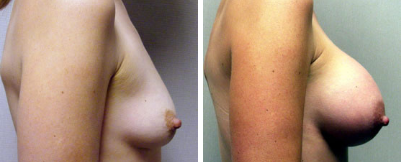 Breast Augmentation with Crescent lift c