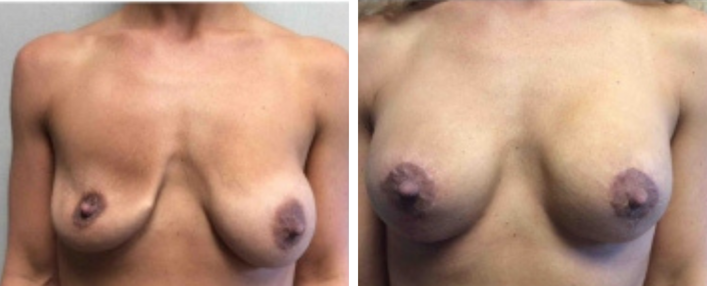 Breast Implant Removal and Replacement in Michigan a