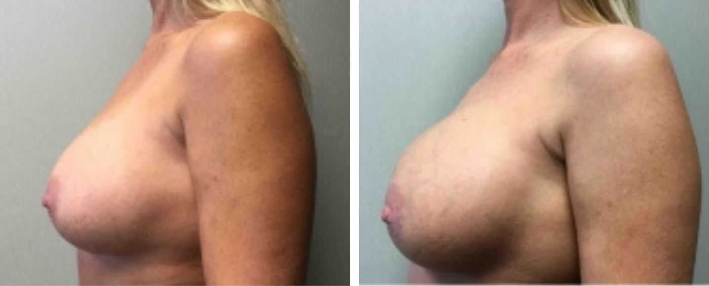 Breast Implant Removal and Replacement in Michigan c