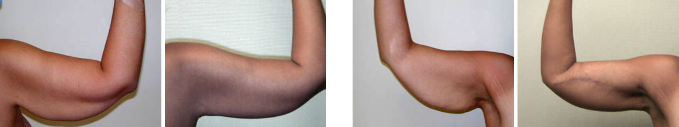 Best Arm Lift In Michgian ()