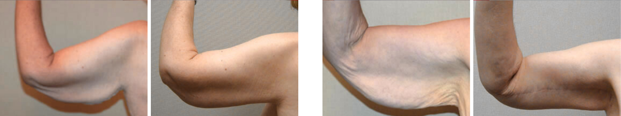 Best Arm Lift In Michgian () Best Arm Lift In Michgian ()